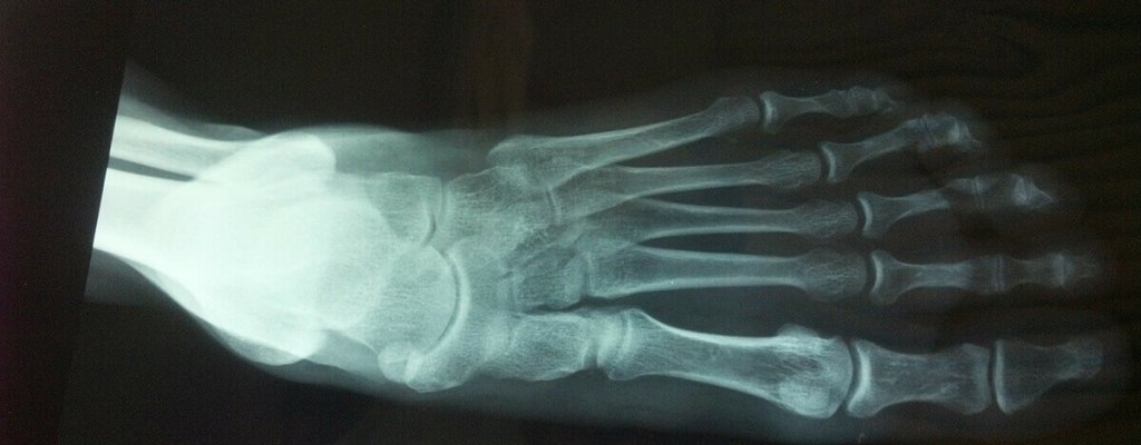 תצלום רנטגן של כף רגל